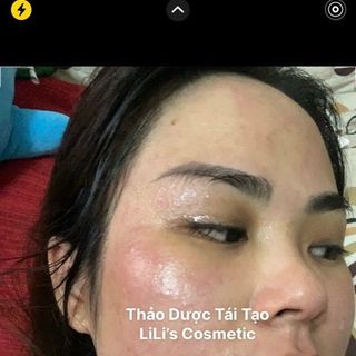 Thảo dược trị mụn tái tạo da liliscosmetic bán sỉ