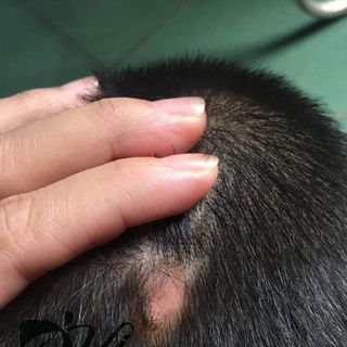 Serum Trị Nấm Da Đầu