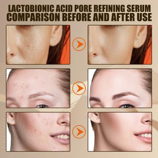 Serum LACTOBIONIC ACID chuyên đặc trị mụn thâm , mụn cám , giúp da se khít lỗ chân lông