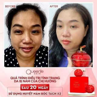 Huyết nám X2 Queenie Skin