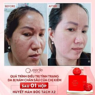 Huyết nám X2 Queenie Skin