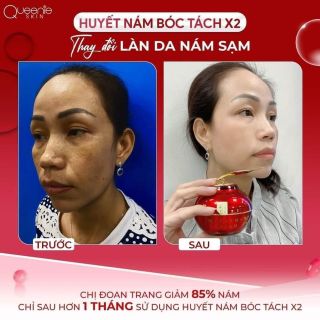 Huyết nám X2 Queenie Skin