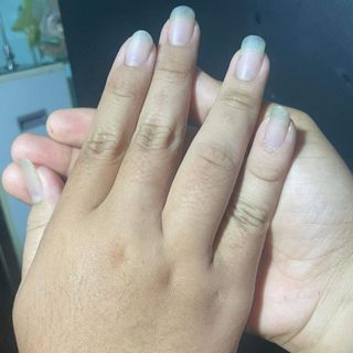 Thuốc gia truyền trị bỏng và các vết thương hở ngoài da