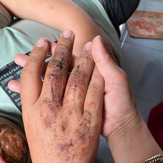 Thuốc gia truyền trị bỏng và các vết thương hở ngoài da