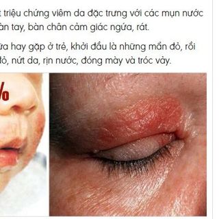 Kem xanh Da Liễu bôi ngứa Bà Lão Hắc Lào Lang Ben Nấm Ngứa