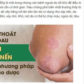 Kem xanh Da Liễu bôi ngứa Bà Lão Hắc Lào Lang Ben Nấm Ngứa
