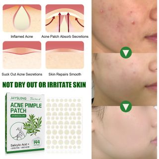 Miếng Dán Trị Mụn Trà Xanh tea tree Oil làm giảm mụn thâm, trị mụn (1hop/144mieng)