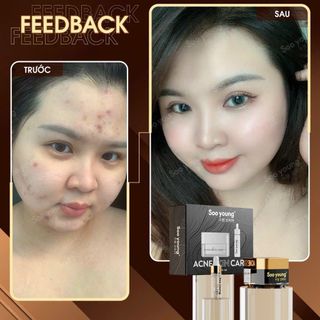 Face mụn sooyoung