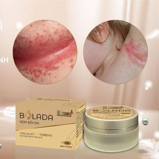 Kem Bôi Da Bolada Đặc Trị Viêm Da Cơ Địa Và Các Bệnh Về Da