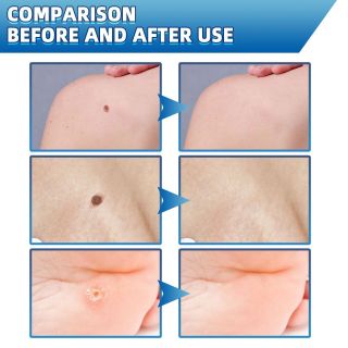 Kem Chuyên Trị Mụn Thịt, Mụn Cóc , Đồi Mồi , Nám , Tàn Nhang cùng các vấn đề về da 20g