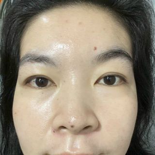 GEL TRỊ MỤN TREAMAX ACNES