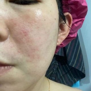 GEL TRỊ MỤN TREAMAX ACNES