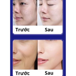 Kem trị giảm nám UCM Japan - Chính Hãng