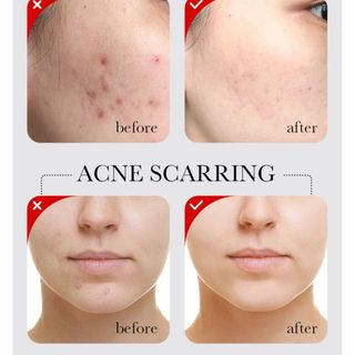 Tinh chất serum mụn AHA+BHA thu nhỏ lỗ chân lông làm sáng 30ml SADOER