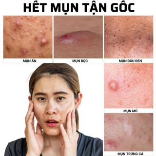 Serum Đặc Tri Mụn ẩn , Mụn đầu đen, Mụn thâm Doctor Care