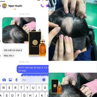 [Chính Hãng] Serum KÍCH MỌC TÓC King Venus (Vs mới của zzVenus): 100% Thiên Nhiên, Kích Tuần Hoàn Máu, Mọc Tóc Con.