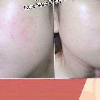 FACE NANO HOA ANH ĐÀO - KEM DƯỠNG TRẮNG DA MẶT NGỪA THÂM NÁM