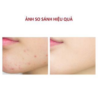 ShowMiracle Sữa rửa mặt dành cho da dầu mụn
