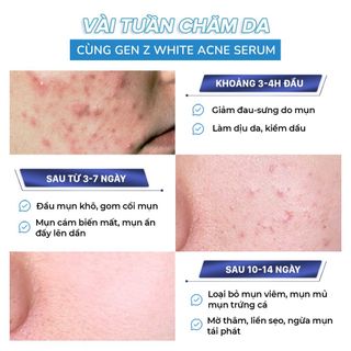Serum Giảm Mụn Oriskin GenZ White Acne Serum Loại Bỏ Các Loại Mụn Viêm, Trứng Cá Và Mụn Đầu Đen 30ml