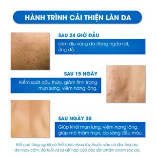 Xịt Mụn Lưng , Ngực , Giảm Mụn Sưng , Mụn Viêm , Mụn Trứng Cá , Giảm Viêm Nang Lông Nữ Oriskin Vicenta Body Mist 100ml