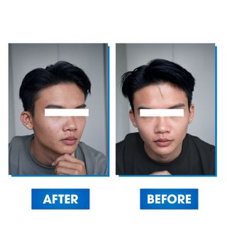 Combo Giúp Hỗ Trợ Giảm Mụn, Giúp Kiềm Dầu , Gồm Serum Genz 30ml ,Sữa Rửa Mặt Oriskin 100ml, Toner 150ml và Tẩy trang 150