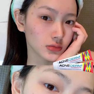 Kem Mờ Mụn Thâm Acne Derm Kwas Azelainowy