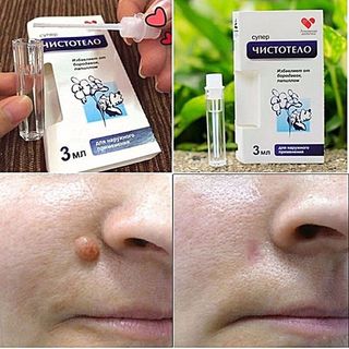 Gel tẩy nốt ruồi,mụn thịt chuẩn Nga - hàng xịn