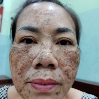 Peel Vi Tảo Thảo Mộc(10ml ) Nhật Nguyệt Beauty ( có chiết rót gia công trọn gói )