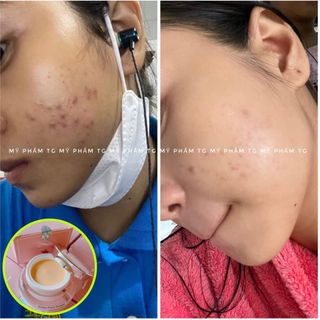 Kem Nghệ Tg Acnes Face Cream 20g