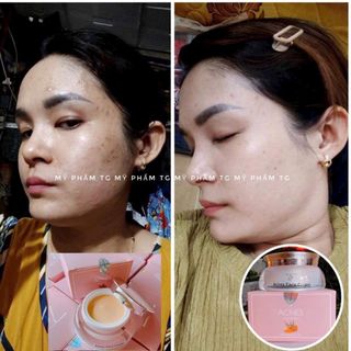 Kem Nghệ Tg Acnes Face Cream 20g