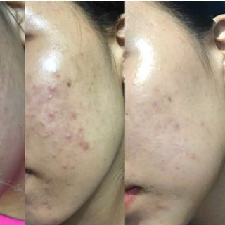Kem Nghệ Tg Acnes Face Cream 20g