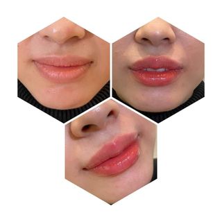 Dưỡng Kích Màu Môi MT collagen sau xăm dưỡng bóng hồng môi tự nhiên