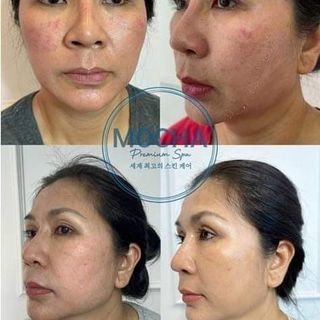 Bộ Peel Mocha Retinol