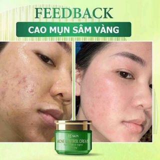 Combo cao mụn sâm vàng MQ Skin