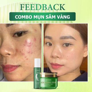 Combo cao mụn sâm vàng MQ Skin