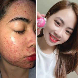 Kem trị mụn hoa anh đào