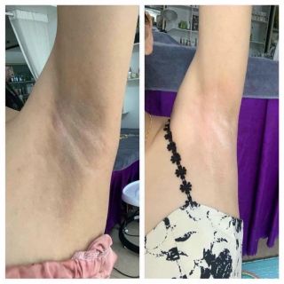 Kem Qnic Thái Lan Giảm Thâm Nách -Thâm bikini 15g (Chuẩn Thái) Mẩu Mới