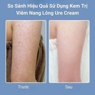 Kem dưỡng ẩm trị viêm nang lông hộp 100gram
