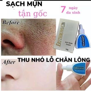 Kem Trị Mụn Sinh Học Nhật Bản Erythromycin