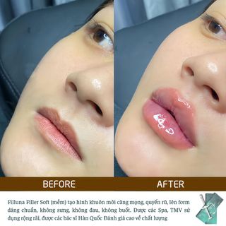 FILLER FILLUNA KOREA TẠO ĐƯỜNG NÉT KHUÔN MẶT