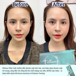 FILLER FILLUNA KOREA TẠO ĐƯỜNG NÉT KHUÔN MẶT