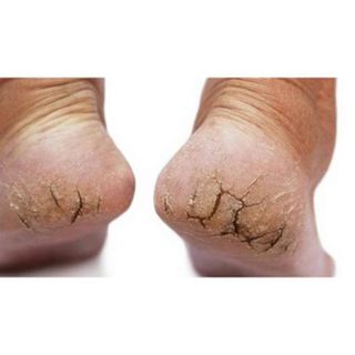 Kem thảo dược bôi ngoài da: nứt nẻ, nấm ngứa, vảy nến, á sừng cực kỳ hiệu quả - CTB798