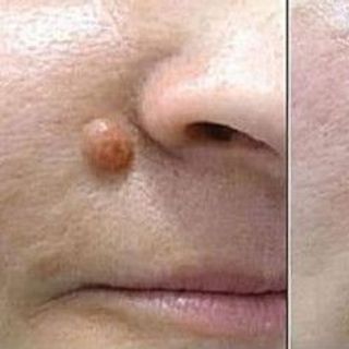 Gel tẩy nốt ruồi mụn cơm mụn cóc nga