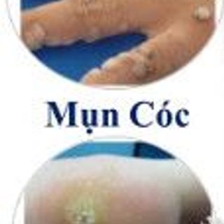 Gel tẩy nốt ruồi mụn cơm mụn cóc nga