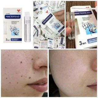 Gel tẩy nốt ruồi mụn cơm mụn cóc nga