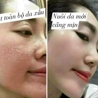 Tái tạo da Phương Anh
