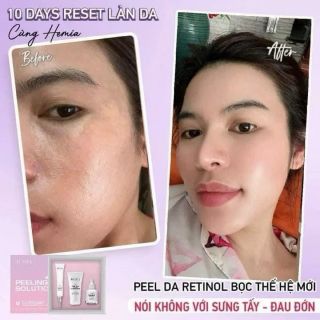 Set Peel Da Hemia Peeling Solution