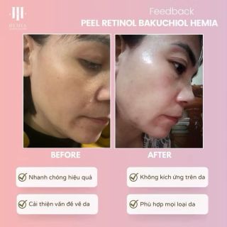 Set Peel Da Hemia Peeling Solution