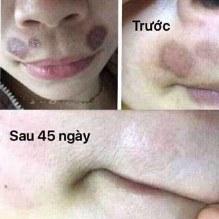Kem Mờ Sẹo Klirvin Nga - Xoá Mờ Thâm, Sẹo Lồi, Sẹo Lõm Rạn Da - 25g