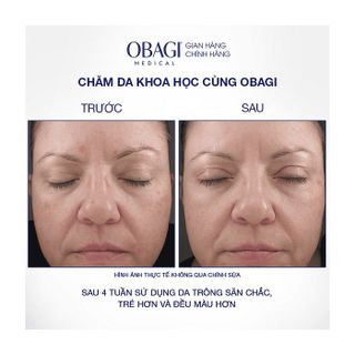 KEM DƯỠNG RETINOL 1.0% TRẺ HÓA DA, NGỪA MỤN OBAGI RETINOL 1.0 CREAM 28G